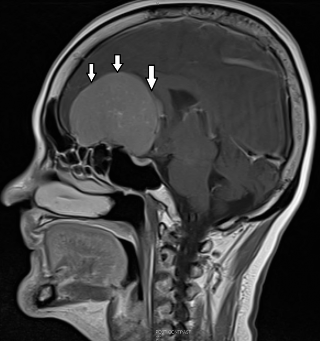 Olfactory groove meningioma