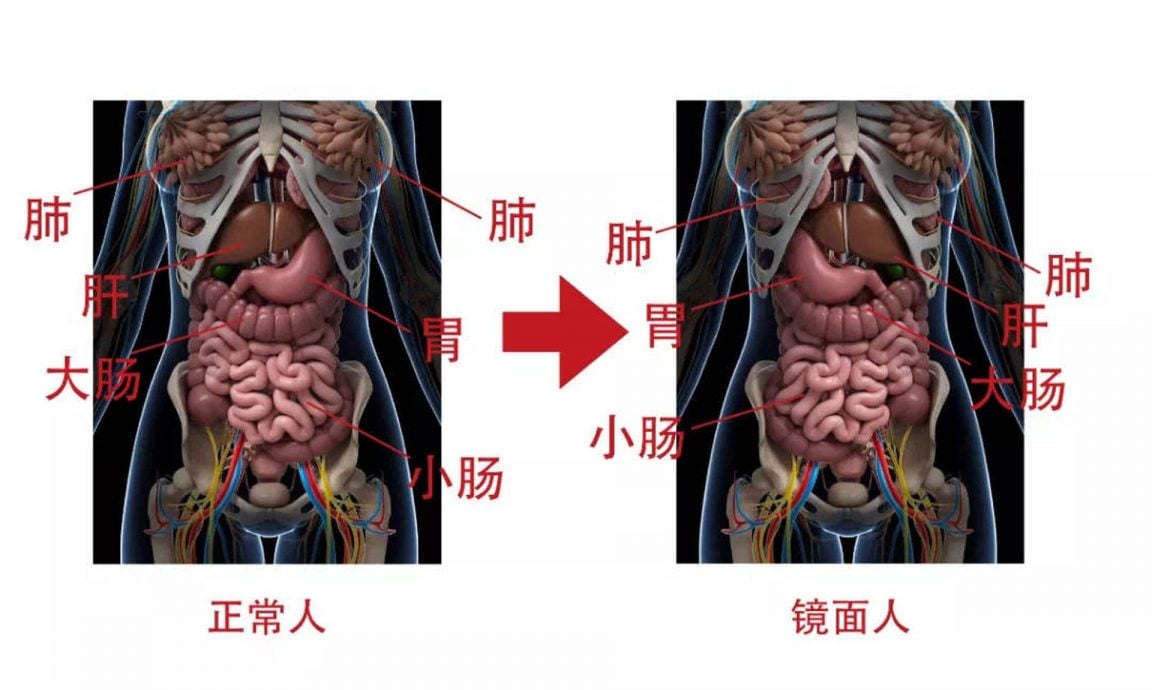 拚盤)疑與冠病感染有關 中國兩醫院報告胎兒內臟反位發病率增加四倍