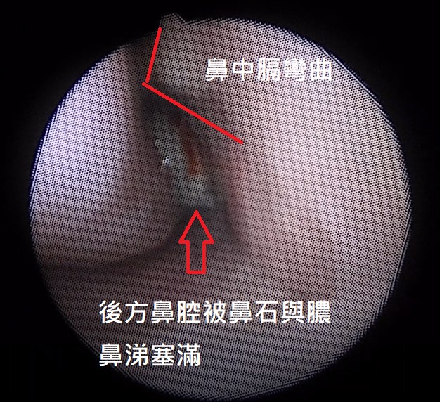 鼻塞10多年呼吸不顺  妇女被挖出巨大“陈年鼻石” 腐臭难闻