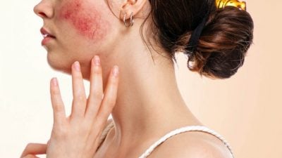 ​陳文恬／患有玫瑰痤瘡超過10年，近年來皮膚越來越敏感，請問中醫怎樣治療？