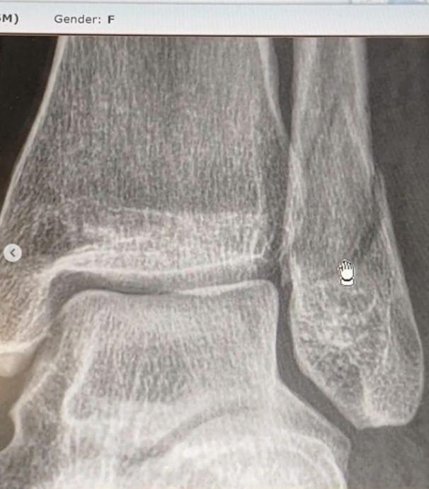 林佩琦摔伤左脚骨折 注入钢钉留4公分疤