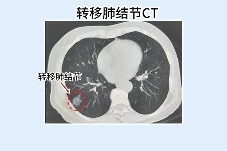 中国肺结节高危人群增至1.5亿人 锺南山：CT与AI助“早诊早治”