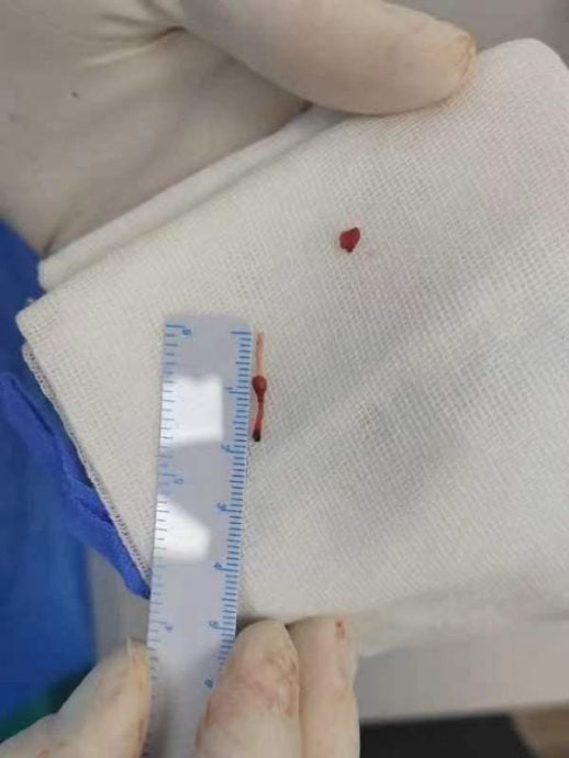 5月大嬰兒輸液 針頭斷在血管裡 5年半後才取出