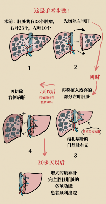 “废弃肝”变“救命肝” 上海完成全球首例“废弃肝”ALPPS手术   