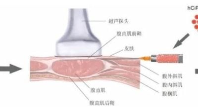 中國科學家利以幹細胞再生療法 功能性治癒1型糖尿病