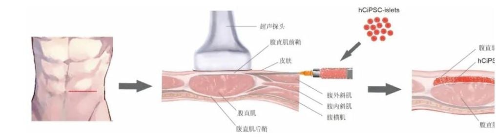  拼盘/中国科学家首次利用干细胞再生疗法功能性治愈1型糖尿病