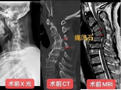  愛喝「骨頭湯」竟險致癱瘓？ 廣東大叔頸椎長10多塊痛風石