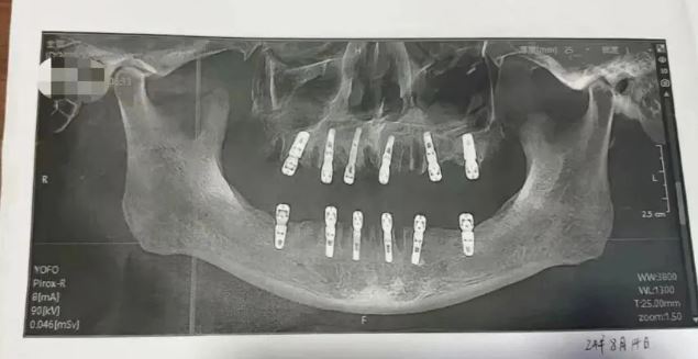 男子一次性拔23牙再种12颗 13天后去世当局调查