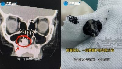 闻恶臭2年 7岁童鼻突流脓 挖出生锈螺丝钉