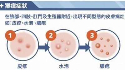 M痘通過密切接觸傳播 水皰脫落前均具傳染性