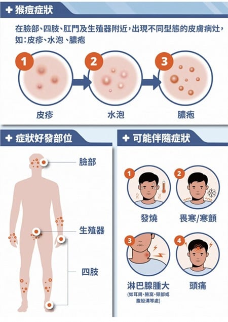 M痘通过密切接触传播 水疱脱落前均具传染性