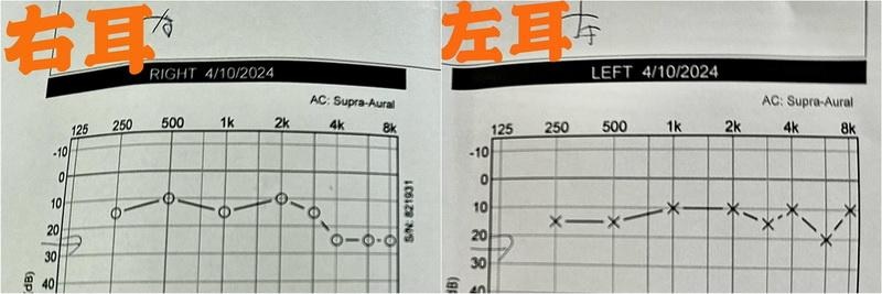 右耳听力康复近9成 古巨基获医生赞“黄金听力”