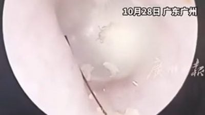 女子耳鳴常聽見機器聲　醫生一看驚見耳內藏活蟑螂