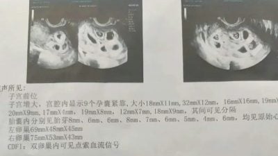 懷九胞胎江西女子二度減胎 最終留下兩胎