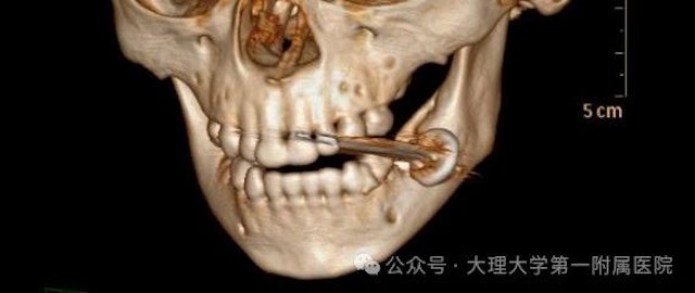 好奇咬电池酿爆炸 2岁童紧急送院