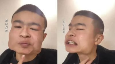 18岁少年嚼槟榔8年  瓜子脸吃成“iPad脸”  网惊: 以为特效