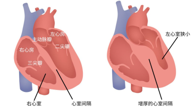 别让‘定时炸弹’在心脏里倒计时，年轻人也需警惕！